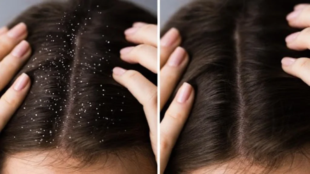 Dandruff Treatment and Scalp Massage